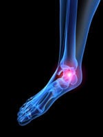 Ankle Pain Joint Pain Treatment