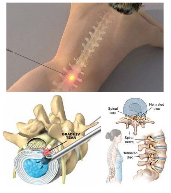 The Mend Procedure for sciatica pain relief