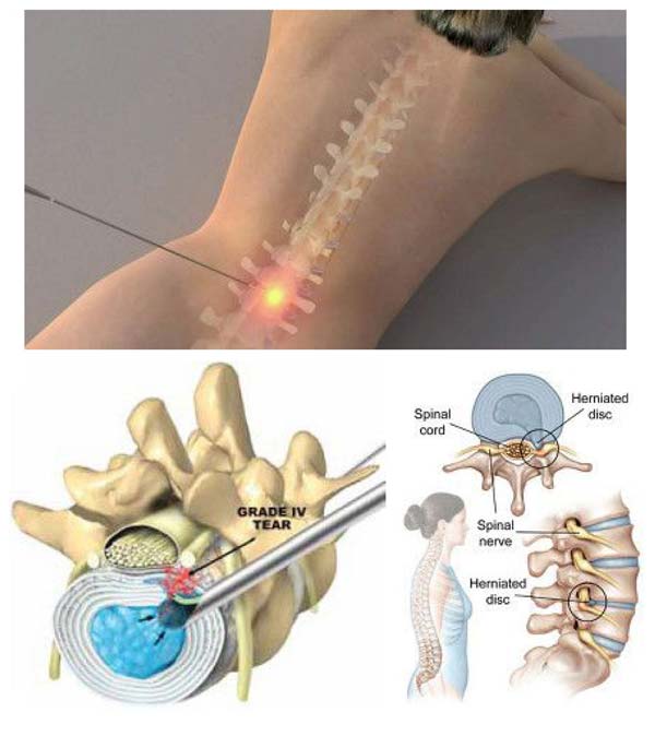 Sciatica - Foundation Therapy